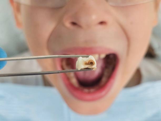 Best Emergency Broken Tooth Repair in Coudersport, PA